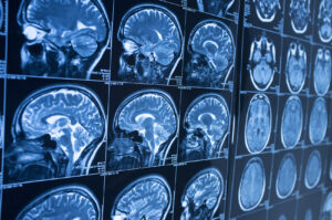 How HJV Car Accident Personal Injury Lawyers Can Help After a Brain Injury in Louisville, KY